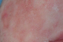 lupus-eritematoso-congenito-hijo-y-madre-2006-004