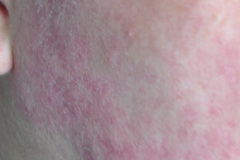 lupus-eritematoso-congenito-hijo-y-madre-2006-005