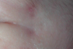 lupus-eritematoso-congenito-hijo-y-madre-2006-009