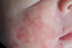 lupus-eritematoso-congenito-hijo-y-madre-2006-011