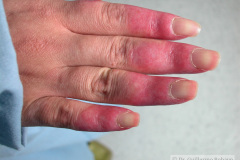 lupus-eritematoso-congenito-hijo-y-madre-2006-013
