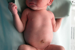 lupus-eritematoso-congenito-hijo-y-madre-2006-016