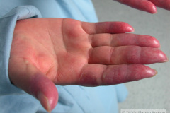 lupus-eritematoso-congenito-hijo-y-madre-2006-017