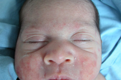 lupus-eritematoso-congenito-hijo-y-madre-2006-019