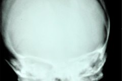 macrocranea-hidrocefalia-diastasis-suturas-1986-000