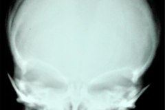 macrocranea-hidrocefalia-diastasis-suturas-1986-001