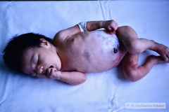 malformacion-ano-rectal-mar-colostomia-dos-bocas-004