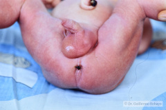 malformacion-ano-rectal-mar-fistula-recto-anal-1987-000