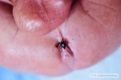 malformacion-ano-rectal-mar-fistula-recto-anal-1987-001