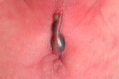 malformacion-ano-rectal-mar-fistula-recto-perineal-2010-000
