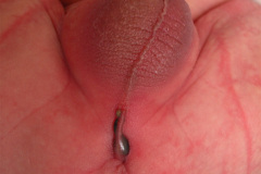 malformacion-ano-rectal-mar-fistula-recto-perineal-2010-001