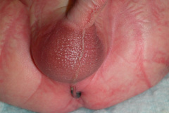 malformacion-ano-rectal-mar-fistula-recto-perineal-2010-002