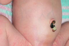 malformacion-ano-rectal-mar-fistula-recto-perineal-2010-005