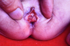 malformacion-ano-rectal-mar-fistula-recto-perineal-001