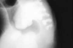 malformacion-ano-rectal-mar-fistula-recto-vesical-1985-005