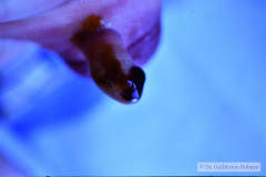 malformacion-ano-rectal-mar-fistula-recto-vesical-1985-011