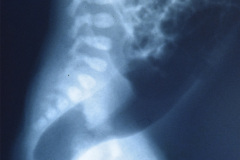 malformacion-ano-rectal-mar-sin-fistula-anoplastia-000