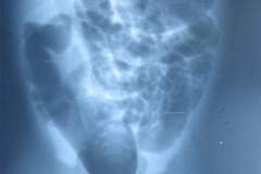 malformacion-ano-rectal-mar-sin-fistula-anoplastia-001