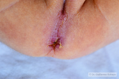 malformacion-ano-rectal-mar-sin-fistula-anoplastia-005