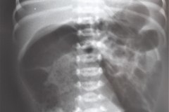 malformacion-anorrectal-mar-1996-001