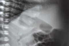 malformacion-anorrectal-mar-con-fistula-1992-000