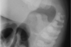 malformacion-anorrectal-mar-invertograma-1985-000