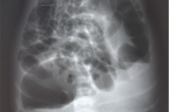 malformacion-anorrectal-mar-invertograma-1986-000