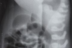 malformacion-anorrectal-mar-invertograma-1995-000