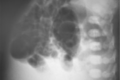 malformacion-anorrectal-mar-invertograma-1996-000