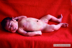 malformacion-venosa-pared-abdominal-1987-000