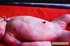 malformacion-venosa-pared-abdominal-1987-001