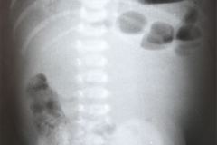 malrotacion-colon-pseudobstruccion-intestinal-colon-enema-1992-005