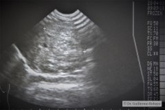 masa-abdominal-flanco-derecho-ecografia-1989-000