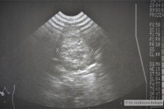 masa-abdominal-flanco-derecho-ecografia-1989-001
