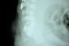 masa-lumbar-meningocele-oculto-000