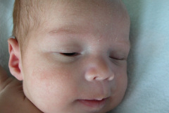 mastoiditis-der-1m-5d-2005-004