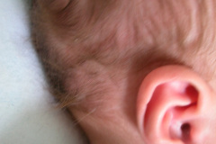 mastoiditis-der-1m-5d-2005-005