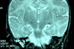 mastoiditis-der-tac-rnm-1m-2005-000