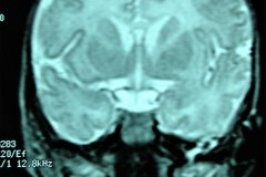 mastoiditis-der-tac-rnm-1m-2005-001