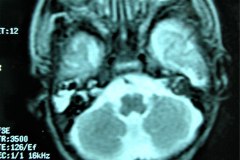 mastoiditis-der-tac-rnm-1m-2005-002