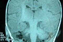 mastoiditis-der-tac-rnm-1m-2005-004
