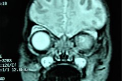 mastoiditis-der-tac-rnm-1m-2005-005