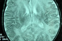 mastoiditis-der-tac-rnm-1m-2005-007