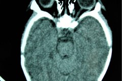 mastoiditis-der-tac-rnm-1m-2005-008
