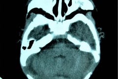 mastoiditis-der-tac-rnm-1m-2005-009