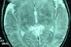 mastoiditis-der-tac-rnm-1m-2005-010