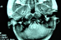 mastoiditis-der-tac-rnm-1m-2005-011