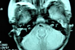 mastoiditis-der-tac-rnm-1m-2005-012