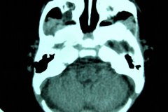 mastoiditis-der-tac-rnm-1m-2005-013