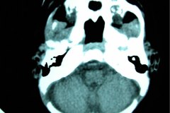 mastoiditis-der-tac-rnm-1m-2005-014